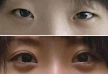 一双眼睛毁掉整张脸，这几种眼睛做双眼皮美爆了，有你没有？