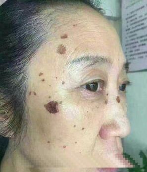 脸上长了“老年斑”不用着急，试试这个小方法，斑不见了脸还白了