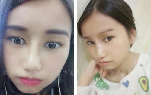  术后■鼻头肥大、山根低、没鼻梁，肋软骨隆鼻后变化有多大？