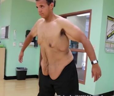 600斤男子每天疯狂减肥，减肥“成功”后，男子却非常的后悔