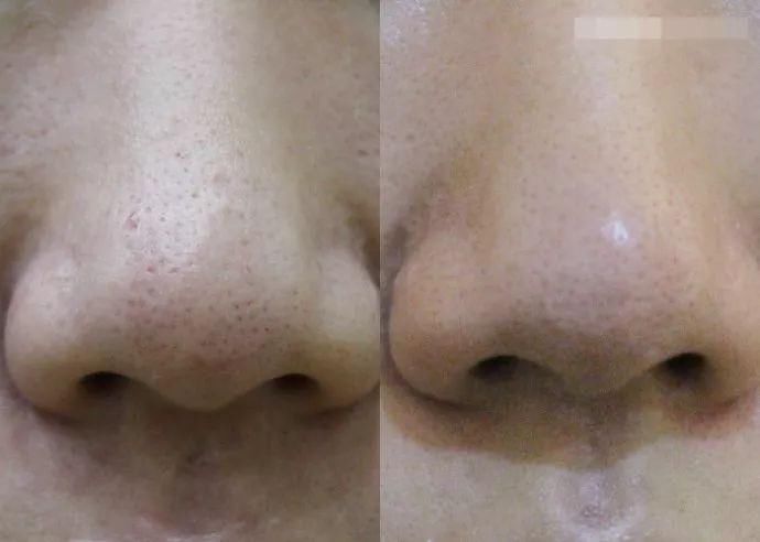 整容遭报应?她的少女脸这么快就烂了?