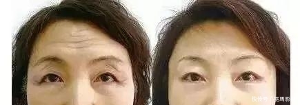  『除皱原理』玻尿酸解决静态皱纹，肉毒素对付动态皱纹，你适合哪个？
