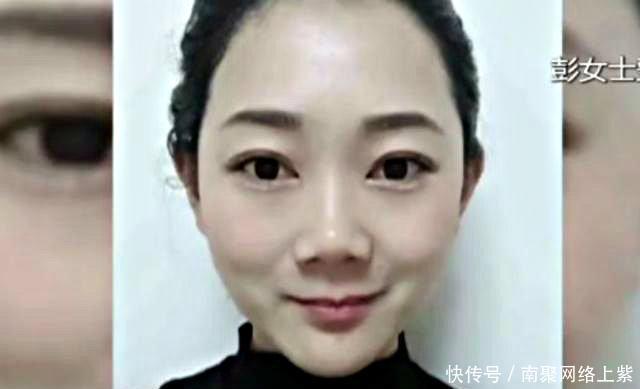 『漂亮』女子花9万元整容, 却脸肿脸烫的受不了, 如今完全像50岁大妈