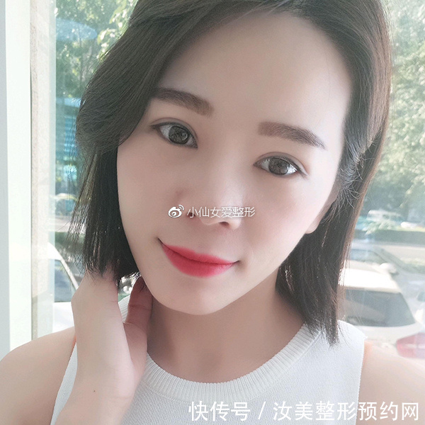 开内眼角前后对比照片，不灵不灵的大眼睛也着实的迷人