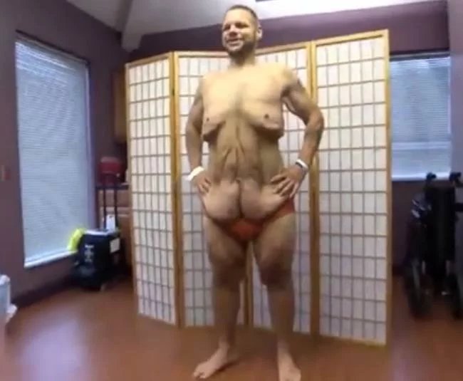体重600多斤的小伙，疯狂减掉400斤，结果皮肤竟变成了这样！
