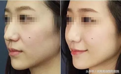 苹果肌和高颧骨之间有超大区别，你分得清楚吗？