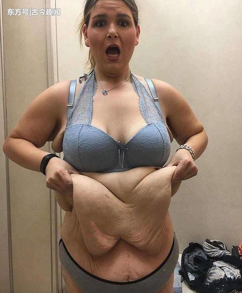 350斤胖妞减掉一半多体重，肚子留下20斤重的赘皮后悔不已！