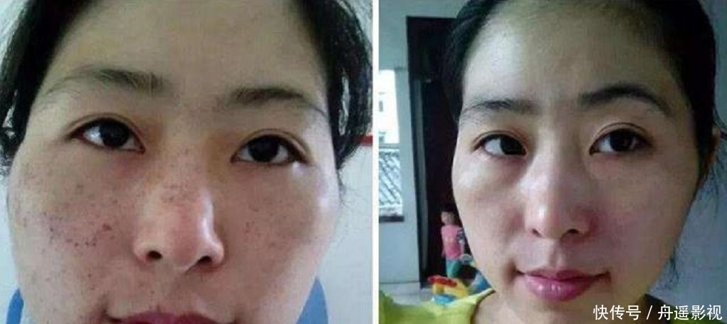 「皮肤问题」白醋加上常见的“它”,敷脸一周色斑、皱纹变淡,皮肤白嫩又细腻