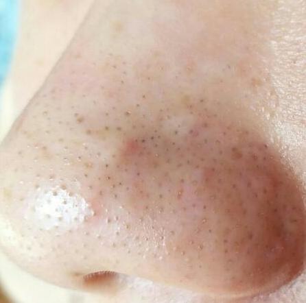 鼻子黑头多, 是螨虫排泄物太多, 除螨2招收入囊中, 黑头不再长