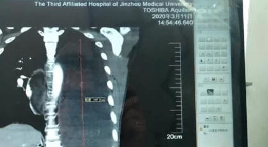  [患者王先生]男子恶心咳嗽，3个月后就医检查：胸腔中藏8斤肉瘤