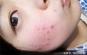 如何去除“闭口粉刺”