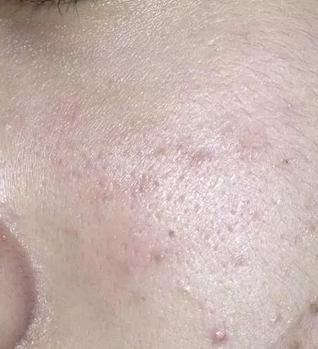 上万螨虫天天在脸上打洞，你的脸会有4种感觉，2个招数清空排净