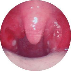 石萍:小儿急性化脓性扁桃体炎的发病率为什么