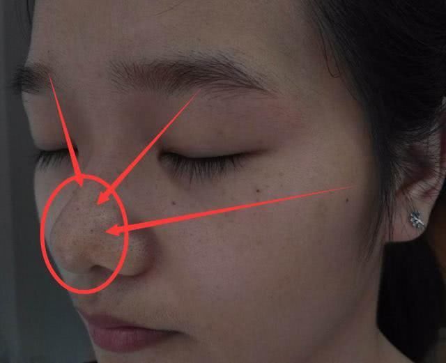 长了“黑头”怎么办？教你2招，让黑头自己跑出去，还不伤皮肤！