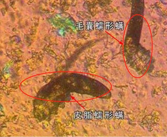 脸上的毛孔像一个个坑，说明过亿螨虫在爬钻咬，用这3招来“补救