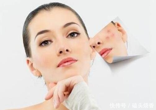 『送给』痘印不知道怎么去?4个小锦囊送给你,能为去痘印帮上忙