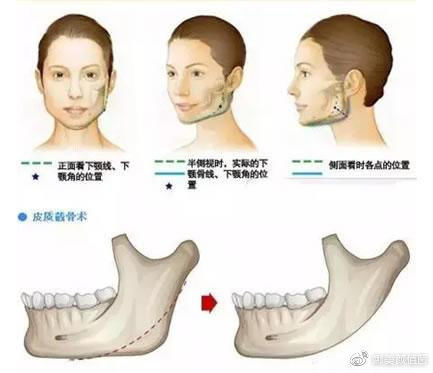  『消肿』颌面部手术后如何快速消肿？