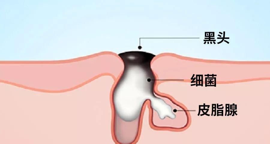 顽固黑头，一招去除，嫩白效果比美颜相机还好!