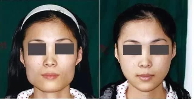  「神经血管」最高级别的整形手术，你知道吗？