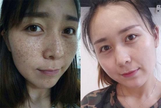 白醋祛斑美白正确方法!7天斑点马上去掉