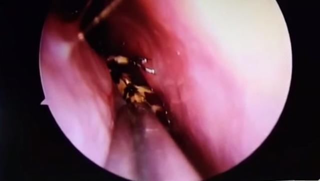 妇女直喊头疼前去检查,发现是脑袋内进了一只