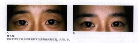 双眼皮“黄金不败宽度”来了!某璐要是早看到也不至于割完眼皮又