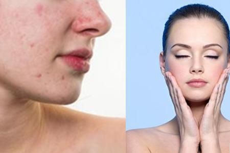 精妆联华:闭口是什么,它会慢慢自己消失吗,