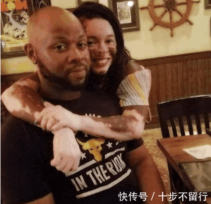 黑人女子皮肤一块块变白, 因次成为网红, 原因却让人感到同情