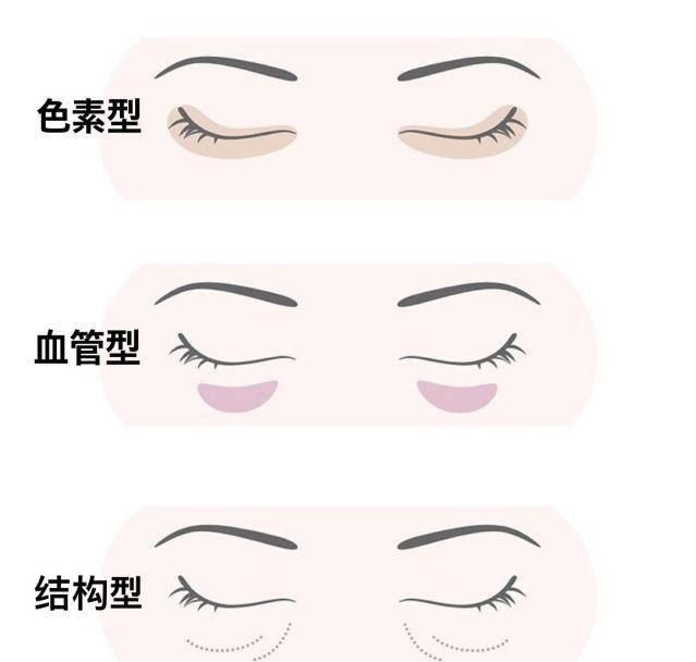  治疗黑眼圈：眼部问题暴露年龄？皮肤科医生教你5个小秘诀！
