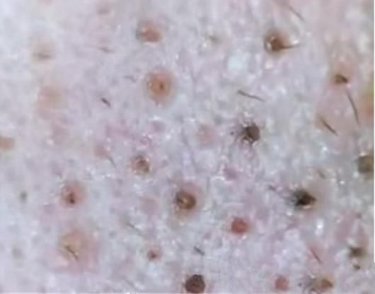 鼻头里挤出这么多“小黄粒”,证明脸上螨虫过亿，3招教你逼退螨虫