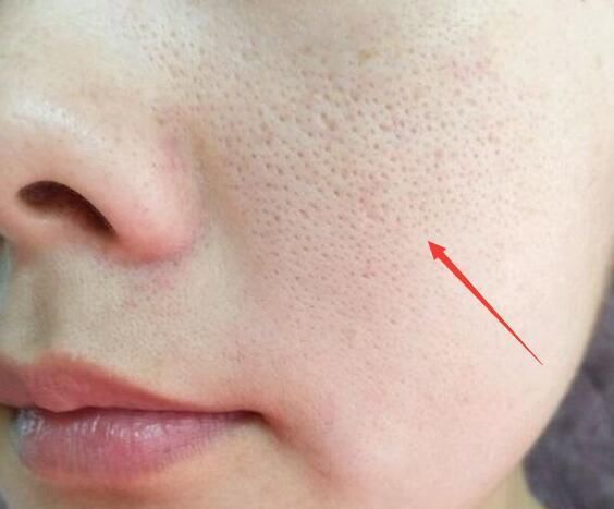 脸上有螨虫,4个问题会出现,再不除螨,脸会是你的负担