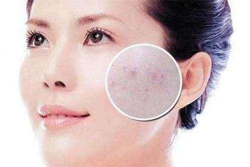脸上毛孔被螨虫堵住的人，这4大表现逃不掉，2方法排螨虫，缩毛孔