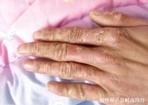 烧伤■烧伤疤痕修复手术多少钱