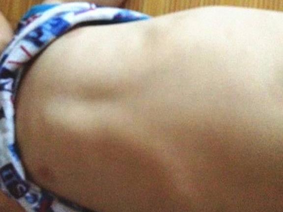 孩子上半身出现“鸡胸”, 都是因为妈妈粗心造成的, 别不当一回事