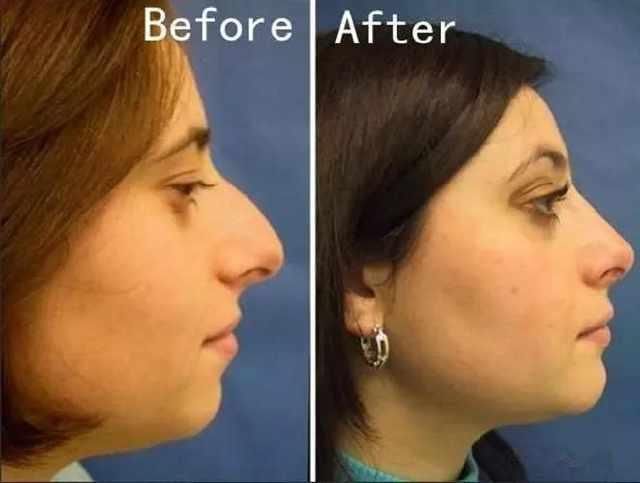 女生有这3种鼻型，一般与美女不搭边!特别第3种，很拉颜值!