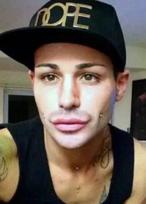 男子痴迷整容,斥巨资在身上动刀,最大的改变居然是臀部!