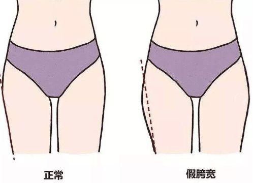 九头身靠p?连女明星都逃不过的“胯宽”问题有办法了!