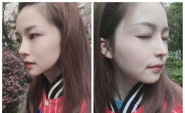  #术后#隆鼻真的有用吗？鼻综合术后六个月记录，这完全不是一个人！