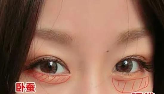  「卧蚕」怎么区分眼袋和卧蚕