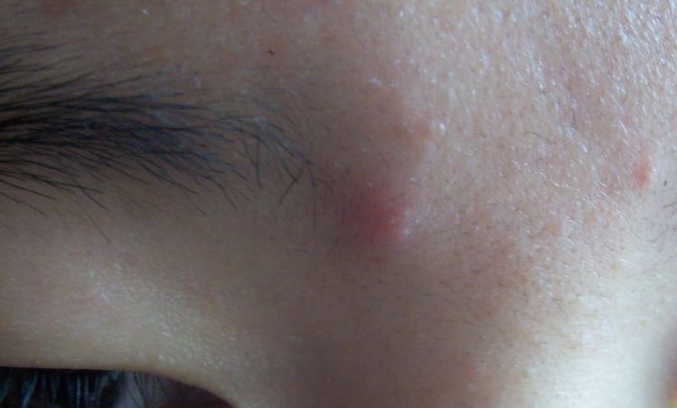  「脸上」脸上总是起痘？美容师：若能做到以下3点，肌肤滑嫩更紧致