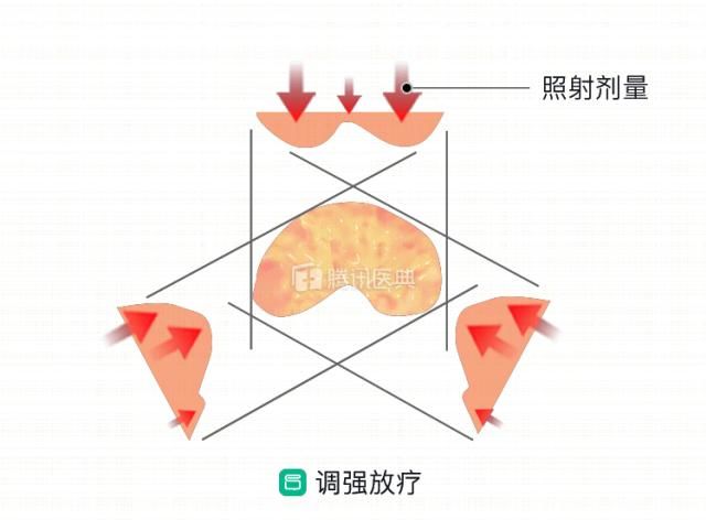  『放疗技术』医治直肠癌，这5大“新武器装备”你一定要了解，能精确杀掉肿瘤干细胞，快看一下