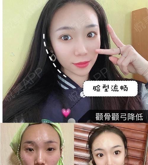  角度■我的下额角磨骨后形成第二个角度,这算不算磨骨失败?