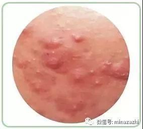 夏日的露肌小性感别让肌肤问题破坏：鸡皮、后背长痘、皮肤太黑…