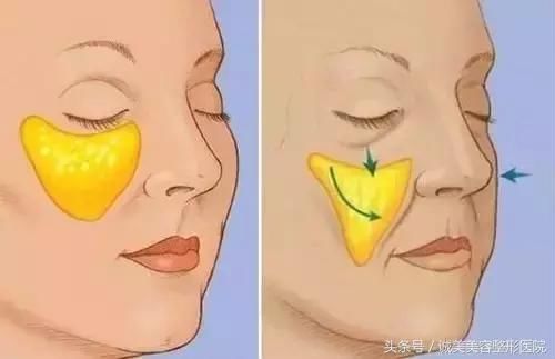 苹果肌和高颧骨之间有超大区别，你分得清楚吗？