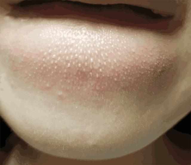 螨虫“聚积”毛孔，脸上4个部位会说话，3方法自测揪出