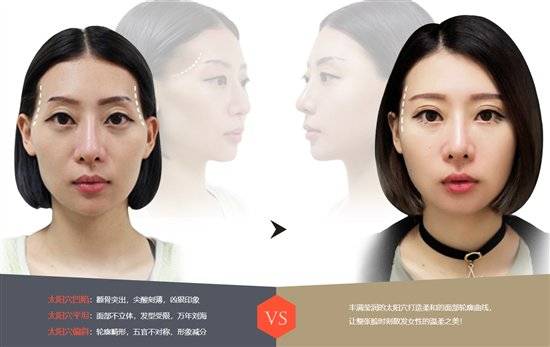 韦元强:为什么太阳穴凹陷会成为普遍现象?