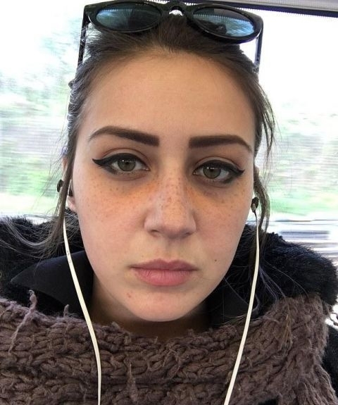 手术:英女子痴迷梅根“雀斑妆”,拙劣手术让面部毁容,花3万治疗修复