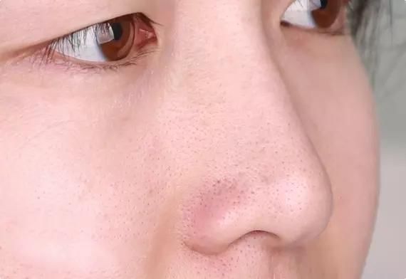 女人鼻子上挤出来的“小白点”是什么？学会2招，让鼻子变干净！