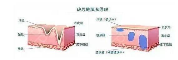 【改善】面部皱纹如何改善,看这里,别让岁月侵蚀了你的美!