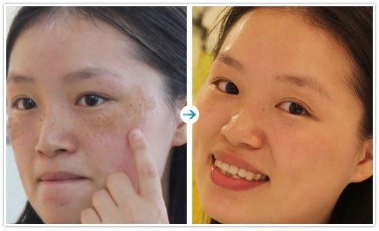 真实祛斑的几种办法和斑说拜拜